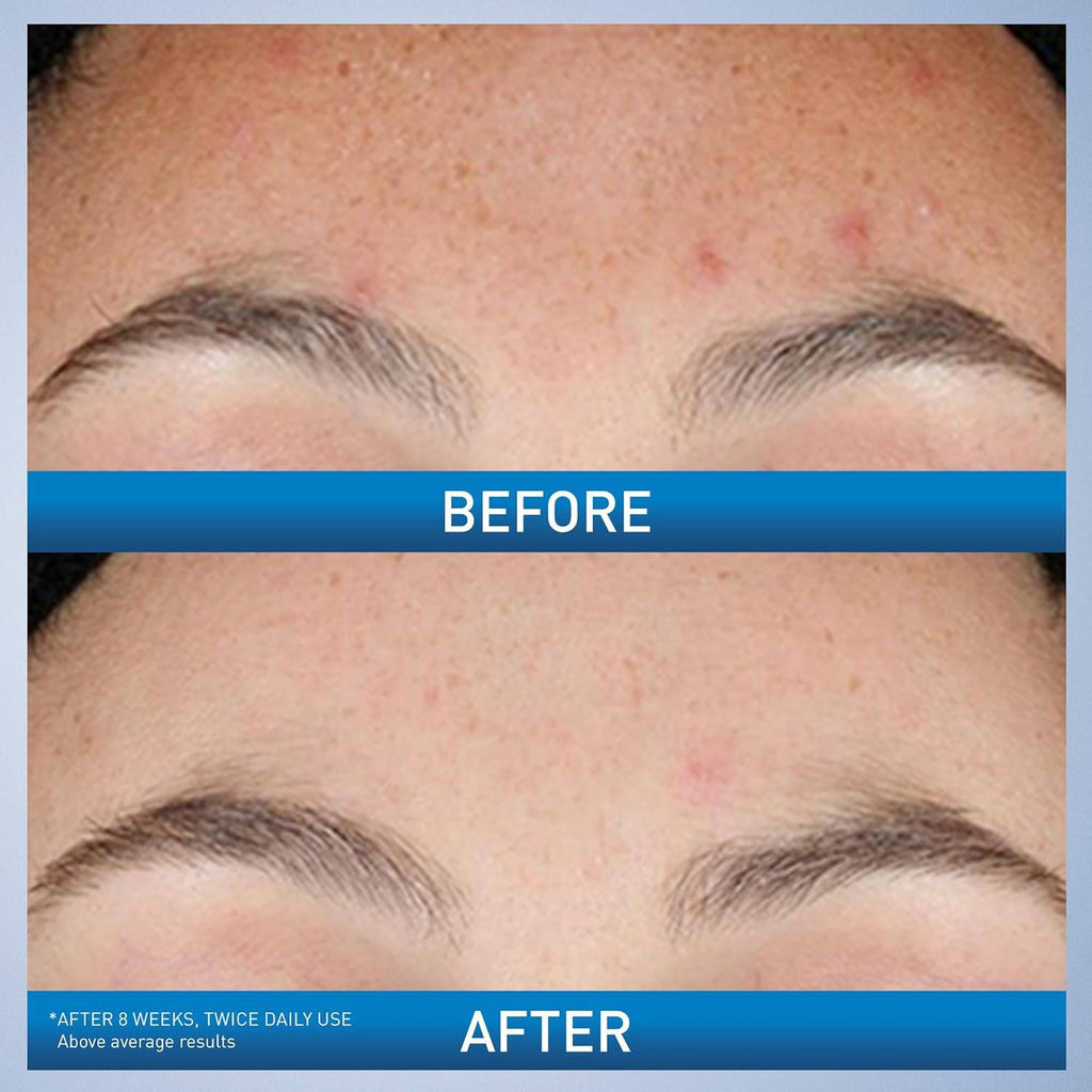 SlimBag CeraVe Resurfacing Retinol Serum with licorice and niacinamide for post-acne marks, brightening, and pore minimization on face