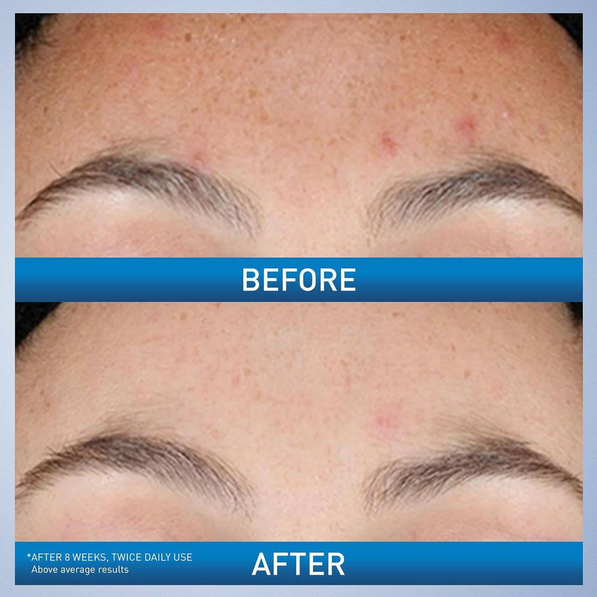SlimBag CeraVe Resurfacing Retinol Serum with licorice and niacinamide for post-acne marks, brightening, and pore minimization on face