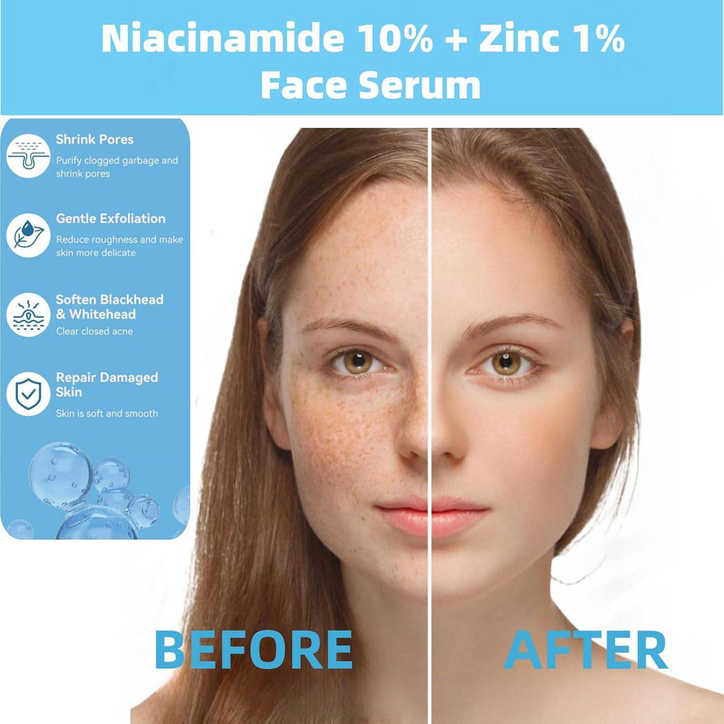 SlimBag Niacinamide 10% + Zinc 1% facial serum bottle, lightweight, non-greasy formula for oil control, acne, pore minimization, blemish reduction